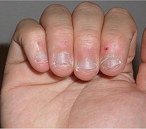 Nail Biting