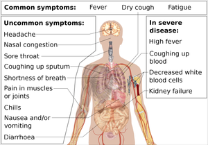 Coronavirus (COVID-19)