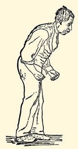 Parkinson's Disease