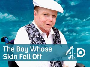 The Boy Whose Skin Fell Off